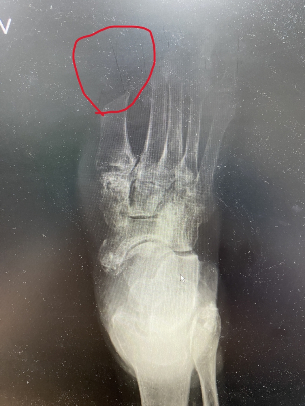 糖尿病石姓男子，腳背潰爛成大洞。（照片員榮提供）