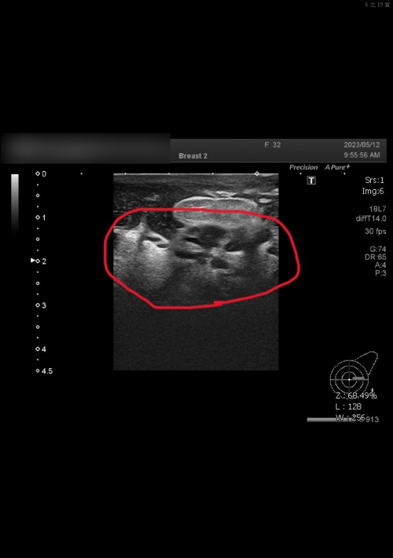 少婦乳房腫痛、潰爛，員榮醫院查出為罕見的結核菌作崇。（照片員榮提供）