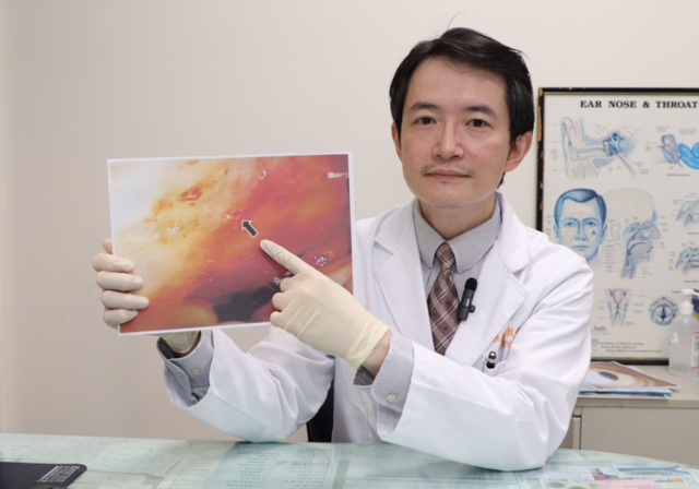 揭開十年頭暈之謎  流鼻血竟是罕見病症警訊