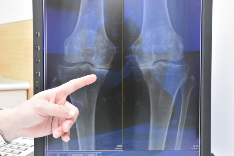 84歲邱姓阿公雙膝蓋因磨損而引發嚴重疼痛。（照片彰基提供）