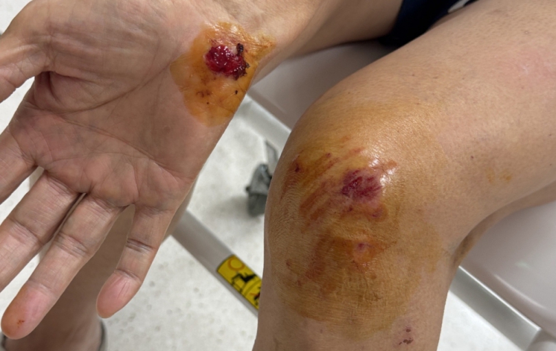 北港人行道窿起絆倒老嫗受傷　家屬籲相關單位應即刻改善