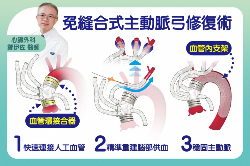 免縫合式主動脈弓混合型手術奪亞洲首獎臺灣之光