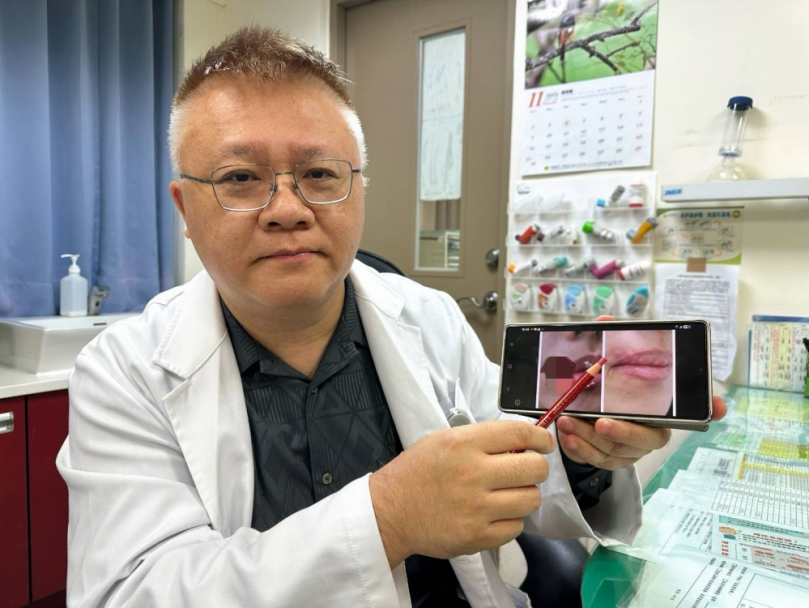 28歲妙齡女被愛犬咬掉嘴邊肉！豐原醫院跨科聯手修復臉部重建奇蹟  把握黃金6小時處置！靠PRP增生療法促進細胞修復搶救成功