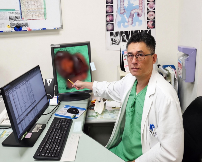 83歲婦腹瀉嘔吐一個月　檢查發現大腸癌合併多器官侵犯 苗栗醫院分階段治療　外科團隊完成多器官腫瘤切除及後續造口關閉