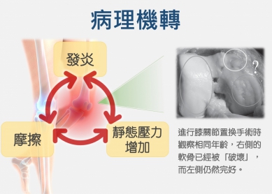 認清骨性關節炎非退化 呂紹睿推動保膝新思維