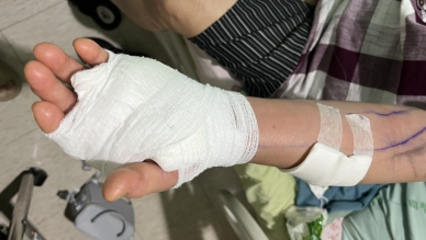 噬肉菌來襲！北港已五起案例　醫示警：傷口感染恐24小時內惡化