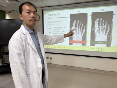 登山男六年兩度拇指外翻    醫師用這手術改善惱人症頭