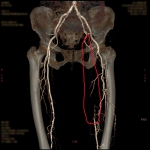 90歲阿祖的左腳側股動脈完全阻塞(圖中紅圈處)。（照片員榮提供）