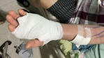 噬肉菌來襲！北港已五起案例　醫示警：傷口感染恐24小時內惡化