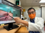 頂尖業務屁股反覆膿瘍8年！  手術切除難言之隱「肛門廔管」告別濕褲困擾